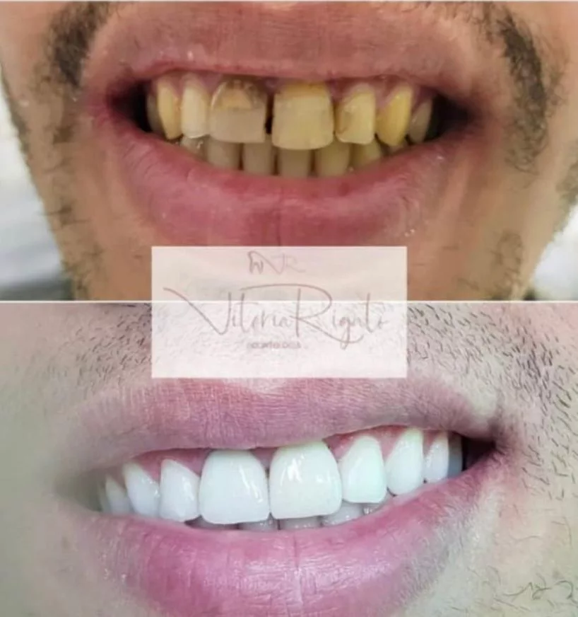 Reabilitação com Facetas em Resina (antes e depois)